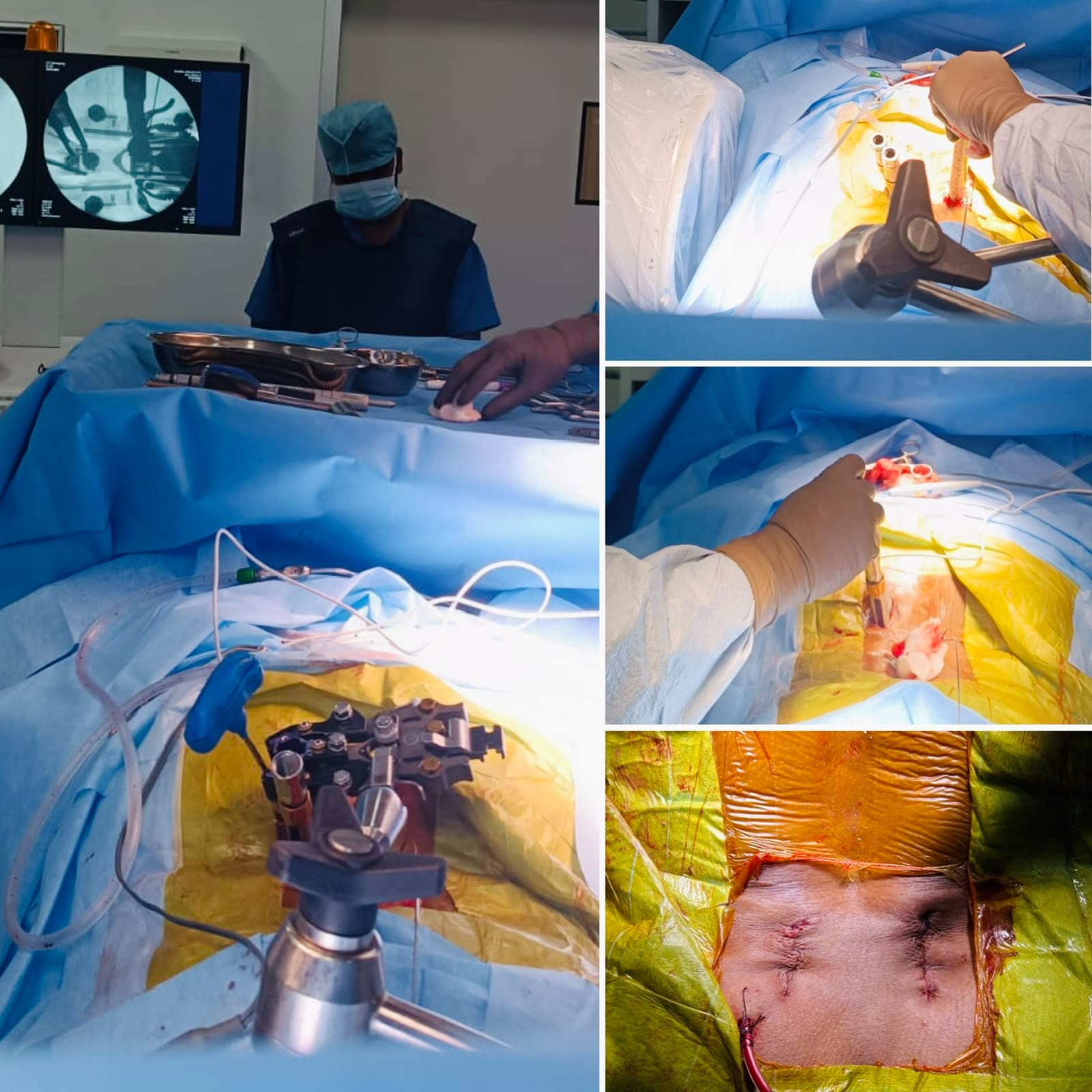 Endoscopic Spine Surgery