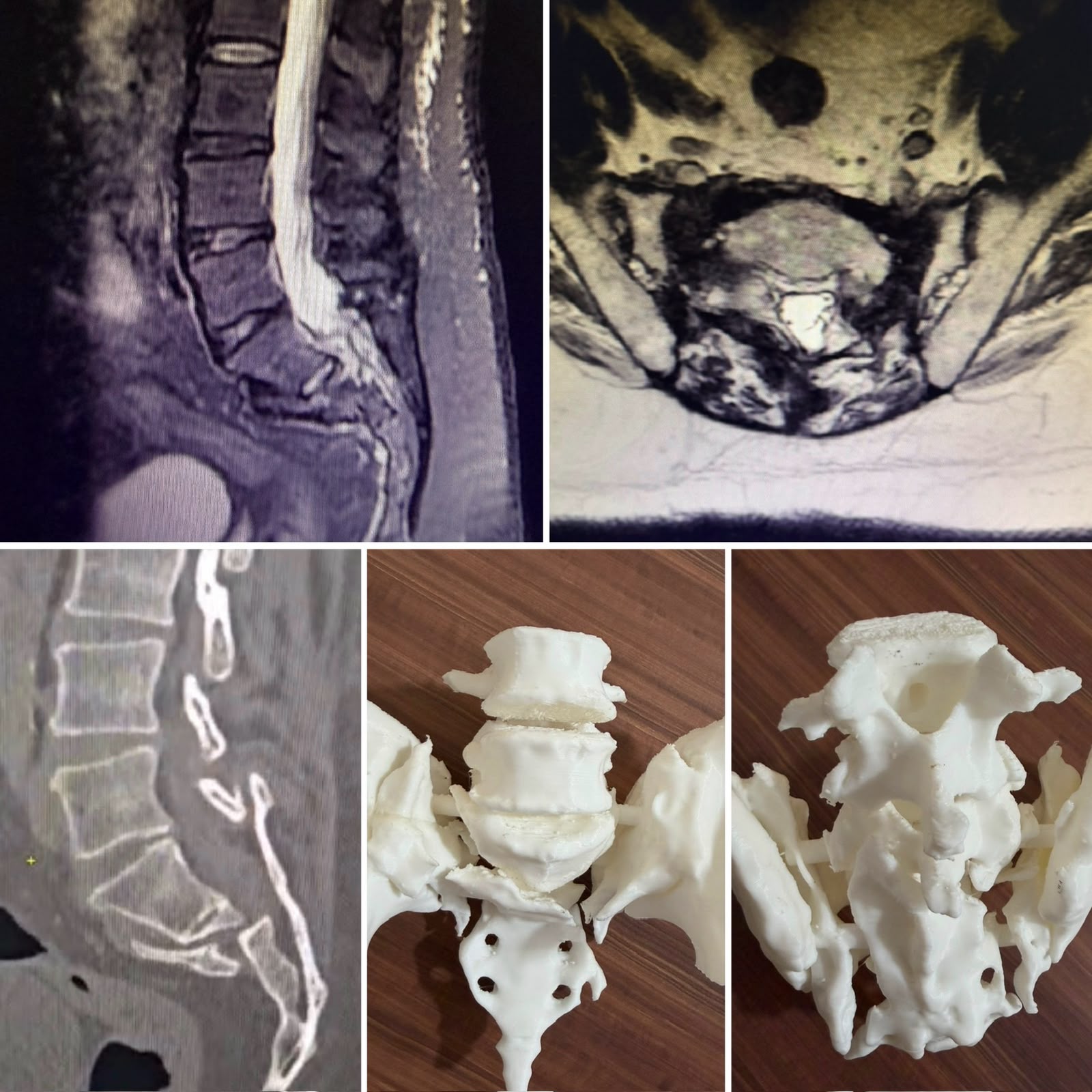 Complex Spine Surgery