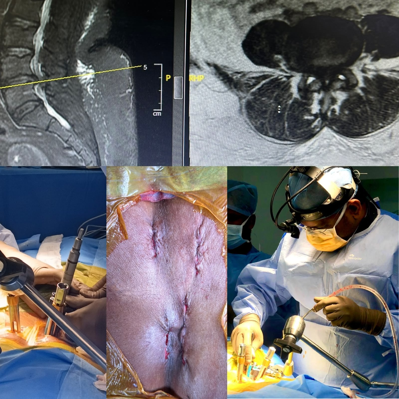 Complex Spine Surgery