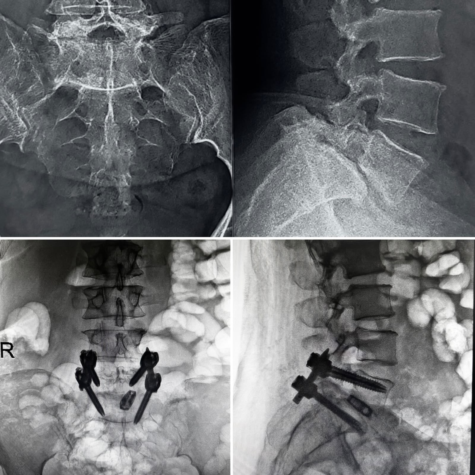 Complex Spine Surgery