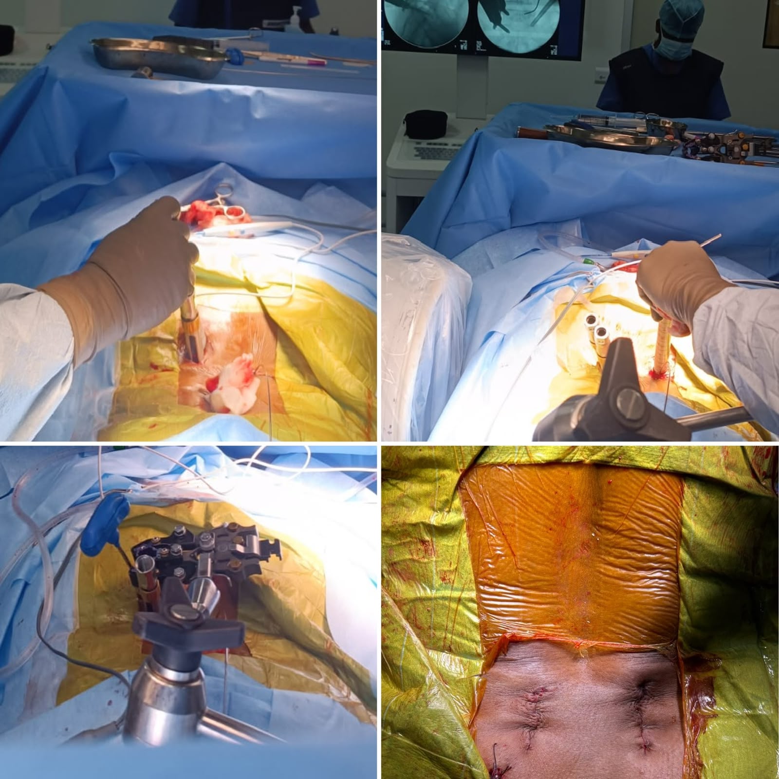 Complex Spine Surgery