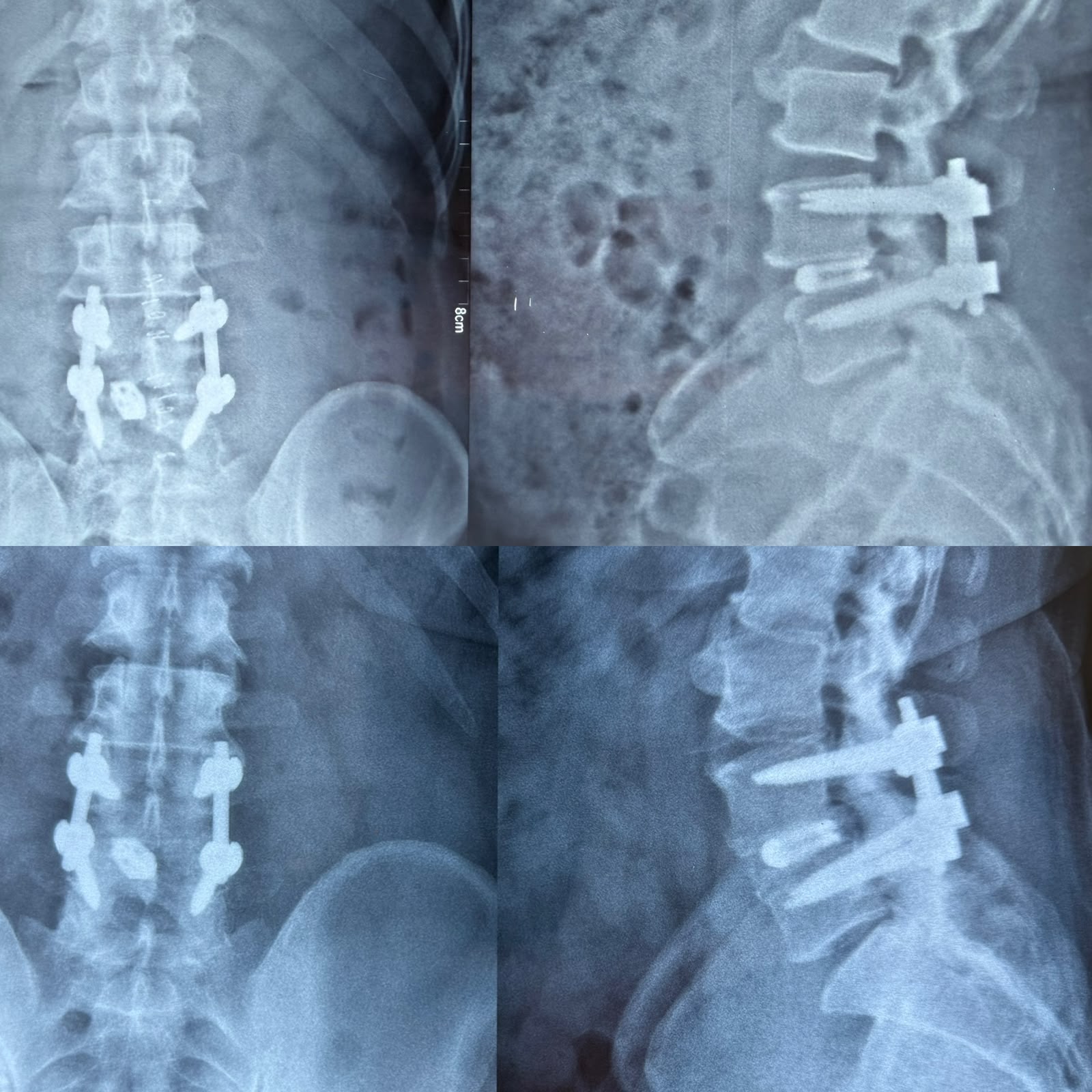Complex Spine Surgery