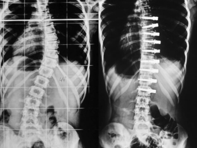 Non-Fusion Scoliosis Surgery vs Spinal Fusion