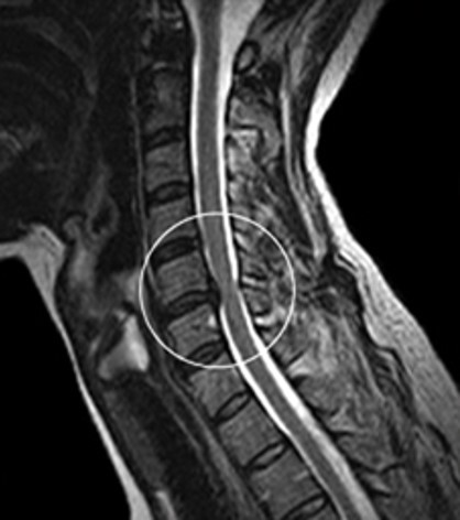 Cervical-Disc-Herniation https://drmdssasidharan.com/wp-content/uploads/2024/04/Cervical-Disc-Herniation.jpg