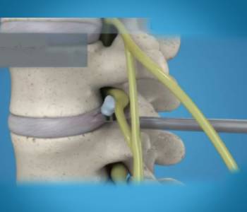 Discectomy https://drmdssasidharan.com/wp-content/uploads/2024/04/Discectomy.jpg