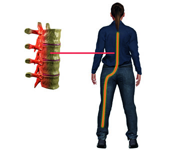 Sciatica https://drmdssasidharan.com/wp-content/uploads/2024/04/Sciatica.jpg