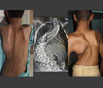 https://drmdssasidharan.com/wp-content/uploads/2024/04/Scoliosis-and-Kyphosis-Correction.png