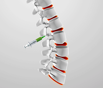 Spinal-Injection https://drmdssasidharan.com/wp-content/uploads/2024/04/Spinal-Injection.png