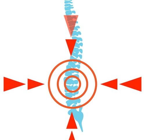 Spinal Stenosis https://drmdssasidharan.com/wp-content/uploads/2024/04/Spinal-Stenosis-500x480.jpg