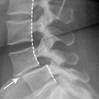 Spondylolysthesis https://drmdssasidharan.com/wp-content/uploads/2024/04/Spondylolysthesis-320x320.jpg