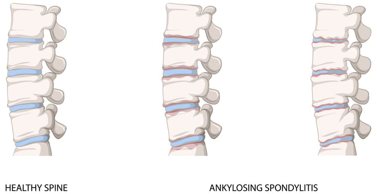 ankylosing https://drmdssasidharan.com/wp-content/uploads/2024/04/ankylosing-1.jpg