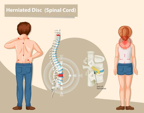 herniated disc https://drmdssasidharan.com/wp-content/uploads/2024/04/herniated-disc.jpg