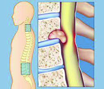 https://drmdssasidharan.com/wp-content/uploads/2024/04/spinal-cord-tumor.jpg
